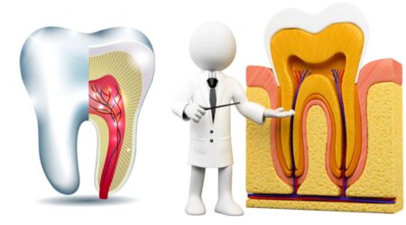 Do Root Canals Cause Health Problems?